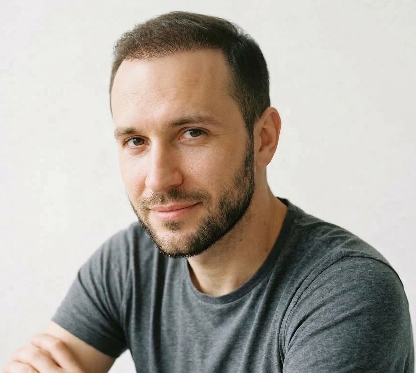 Daniel R. after hair transplant