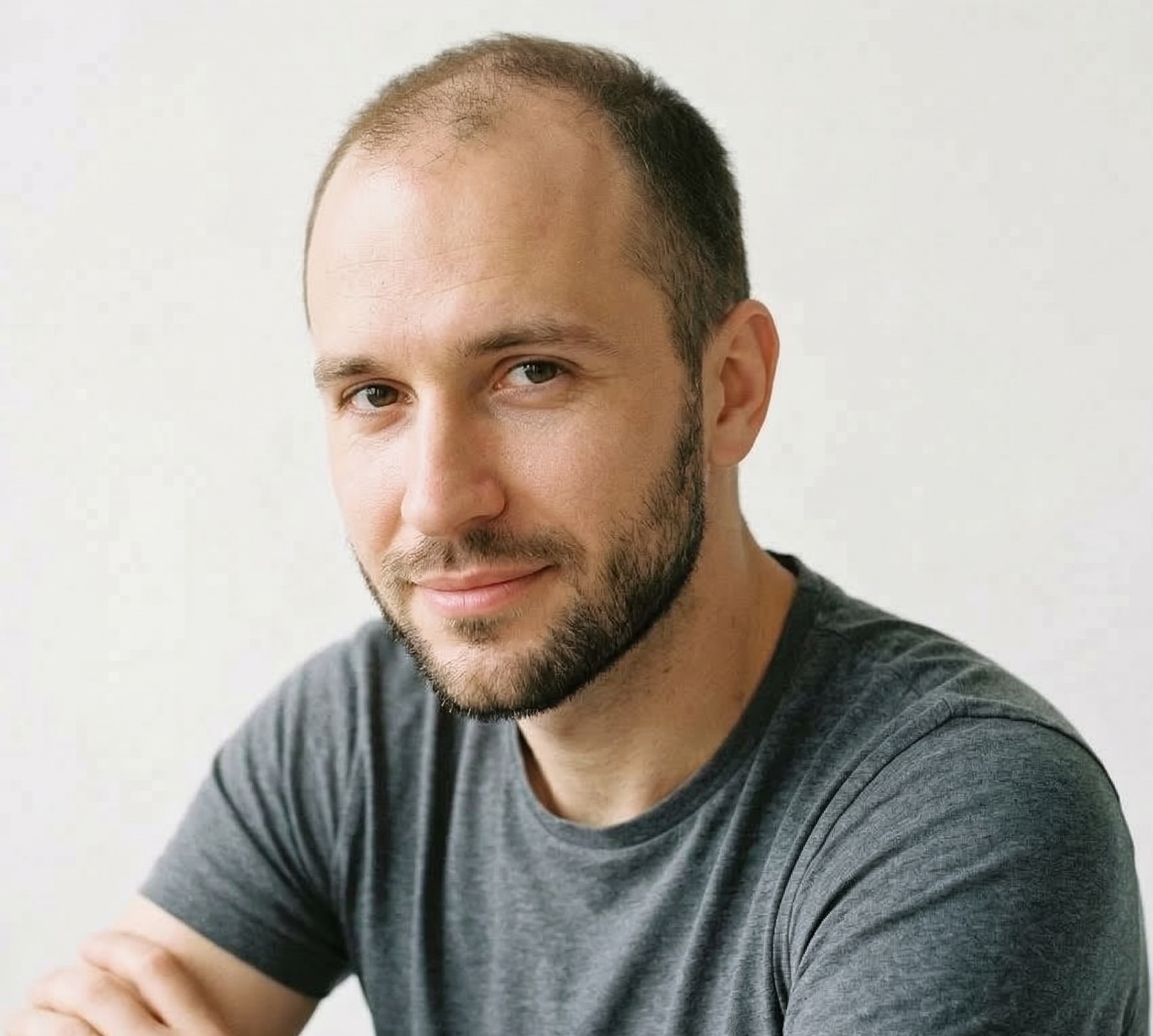 Daniel R. before hair transplant